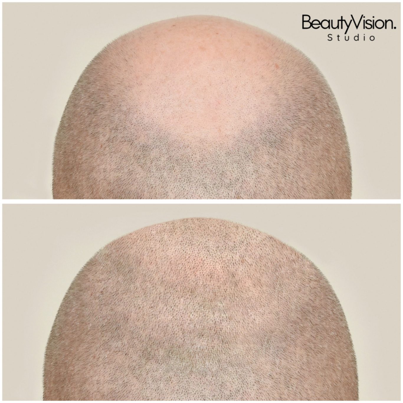 Tonsur - Haarpigmentierung Haarpigmentierung