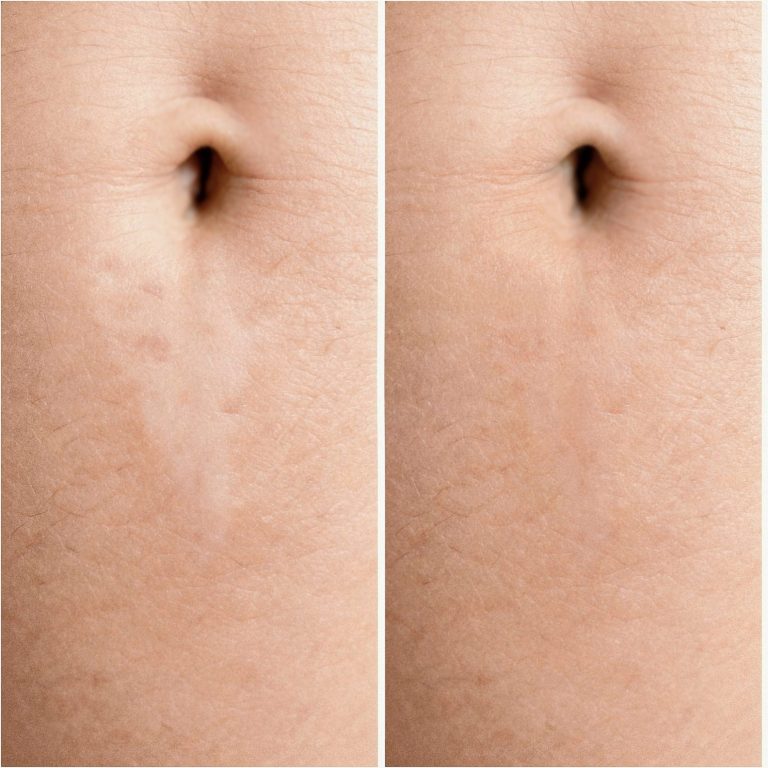 Schwangerschaftsstreifen