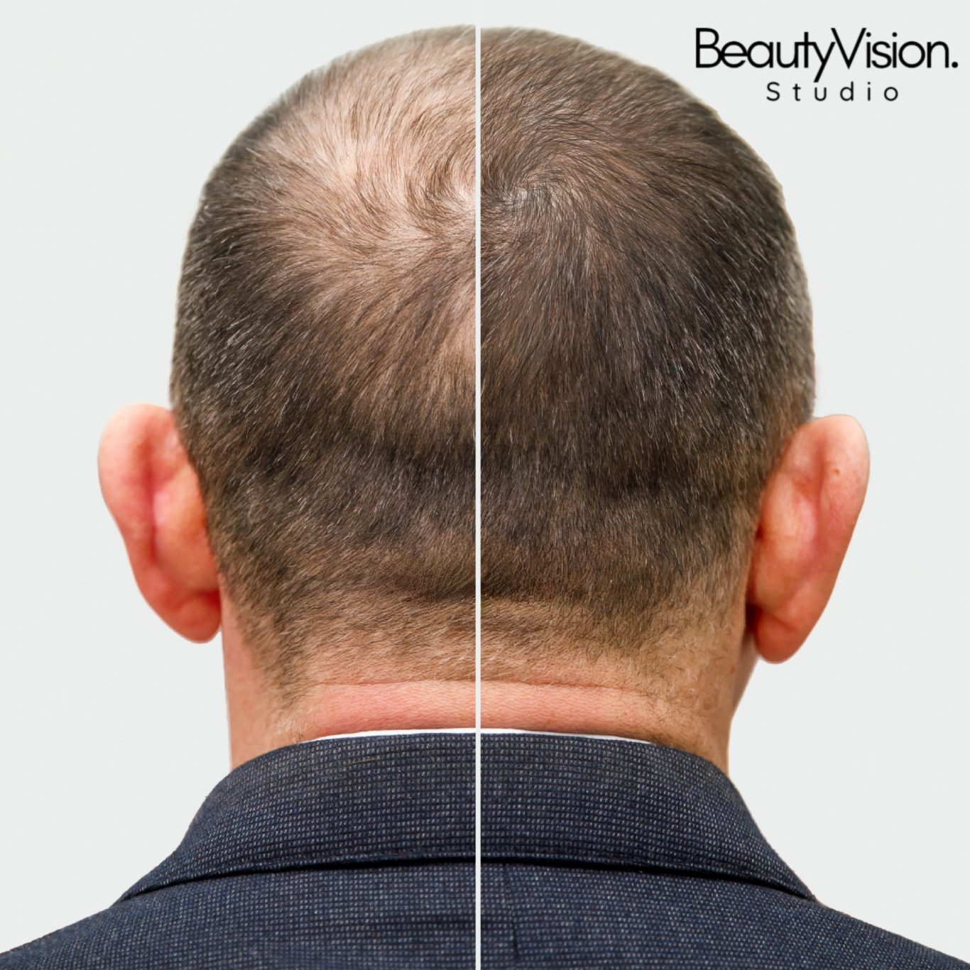 Kopfhautpigmentierung Haar Pigmentierung