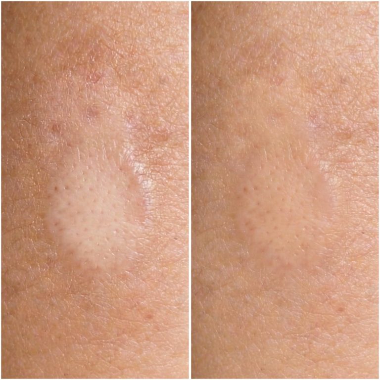 Schwangerschaftsstreifen